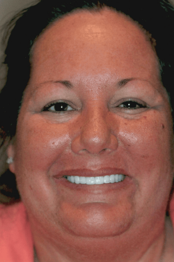 After cosmetic treatment