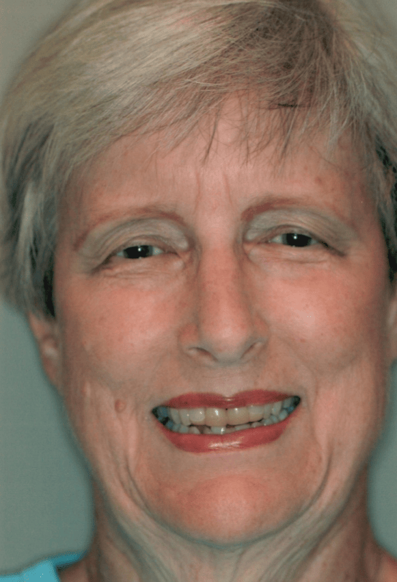 Before smile makeover