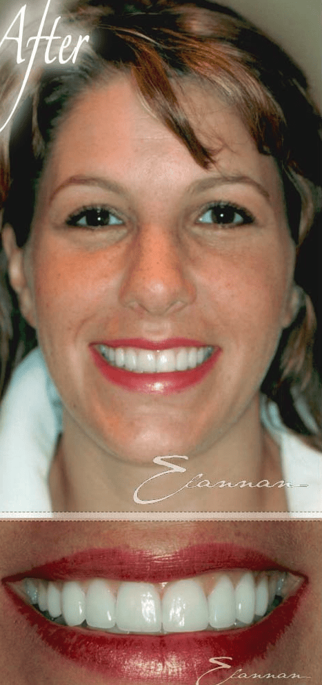 Smile makeover after photo 1