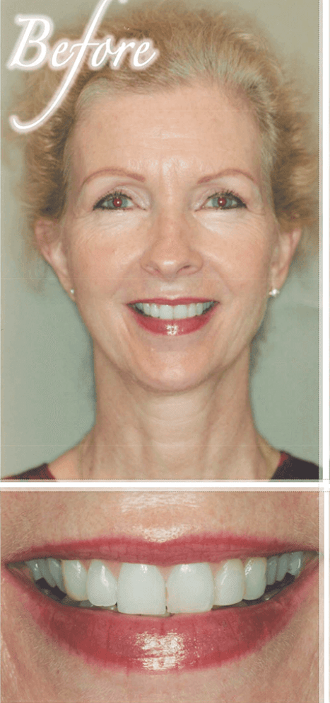 Smile makeover before photo 6