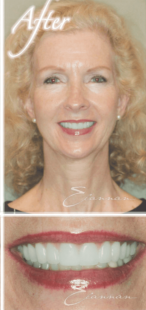 Smile makeover after photo 6