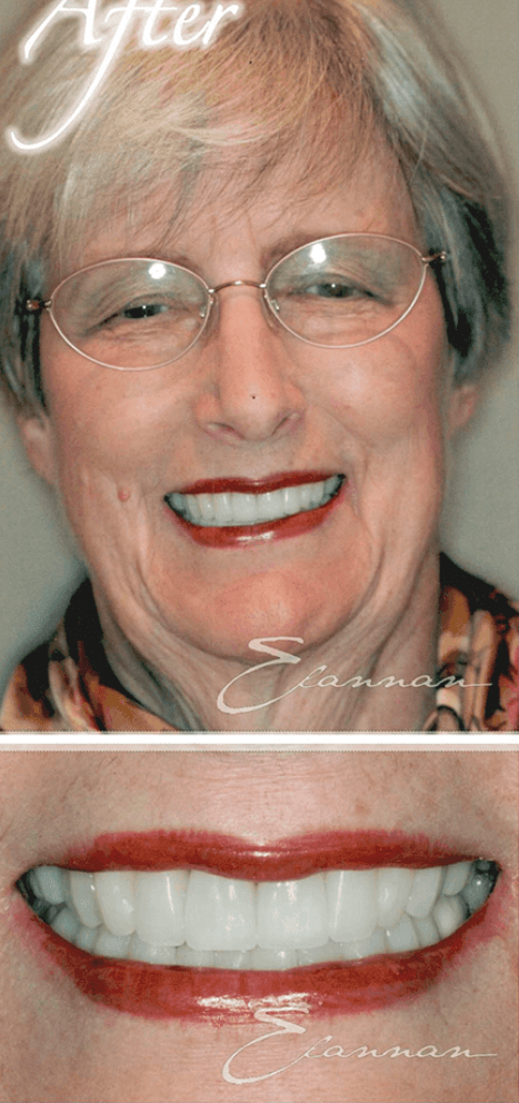 Smile makeover after photo 7