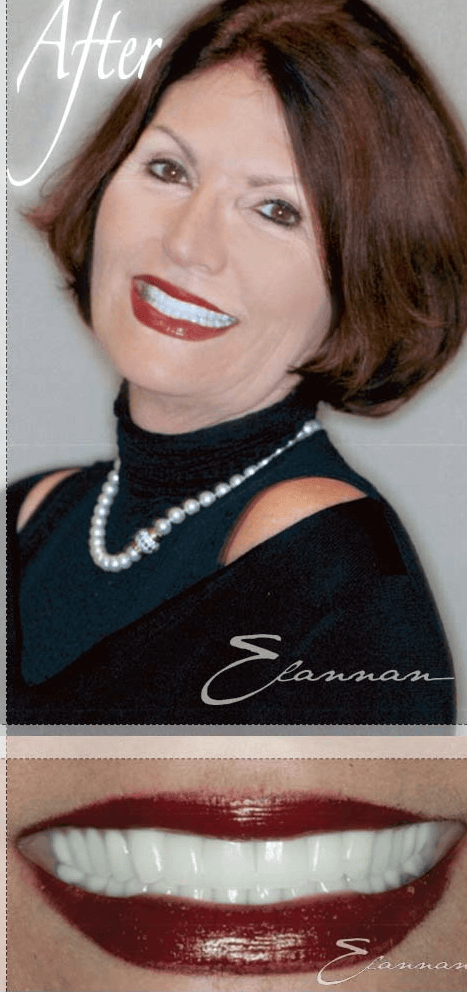 Smile makeover after photo 8