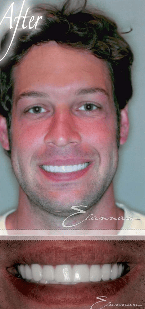 Smile makeover after photo 2