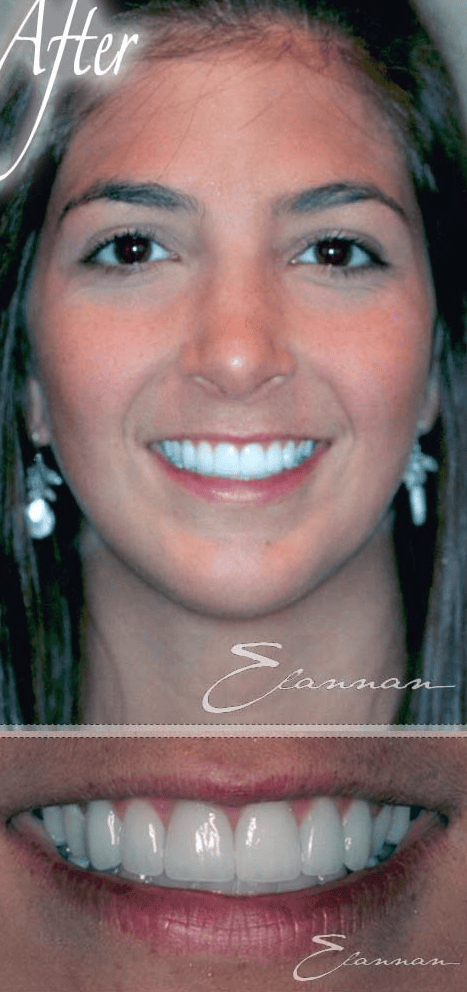 Smile makeover after photo 3
