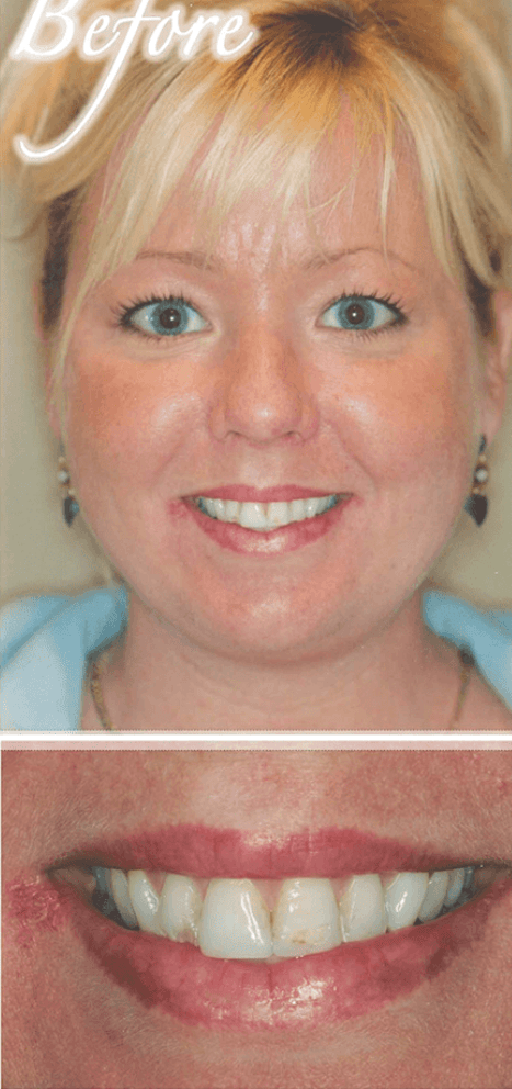 Smile makeover before photo 4