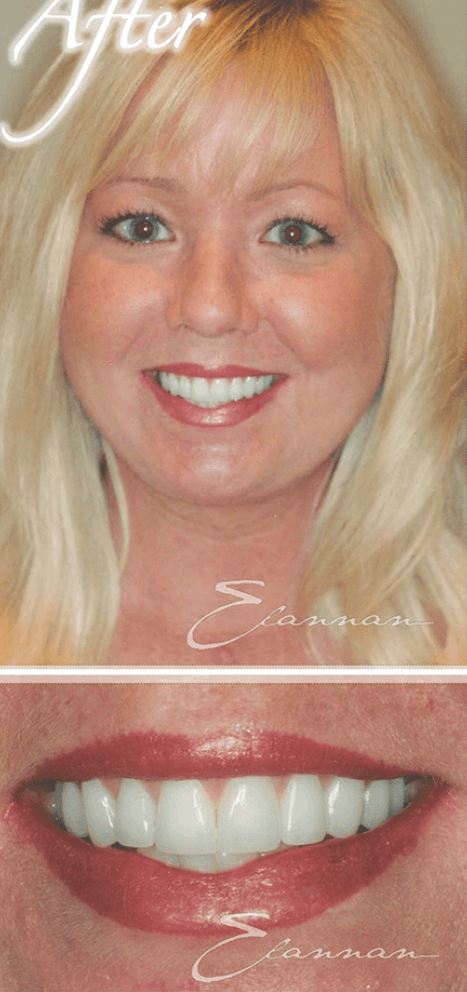 Smile makeover after photo 4
