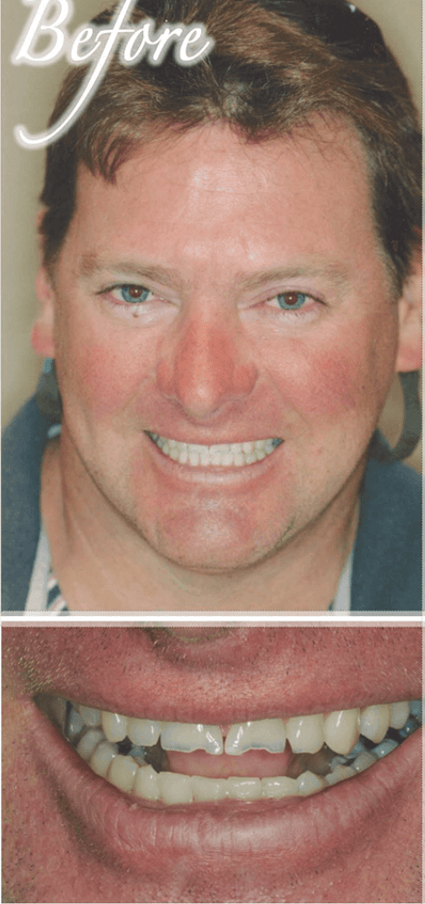 Smile makeover before photo 5