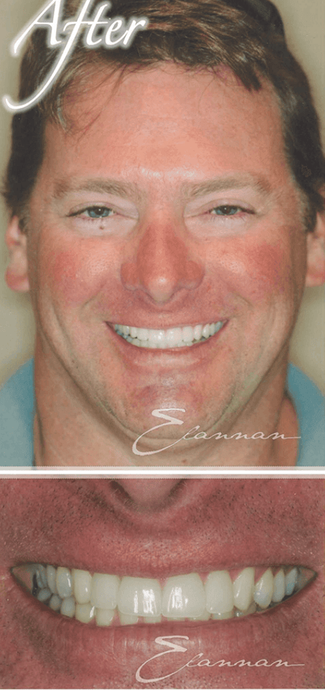 Smile makeover after photo 5